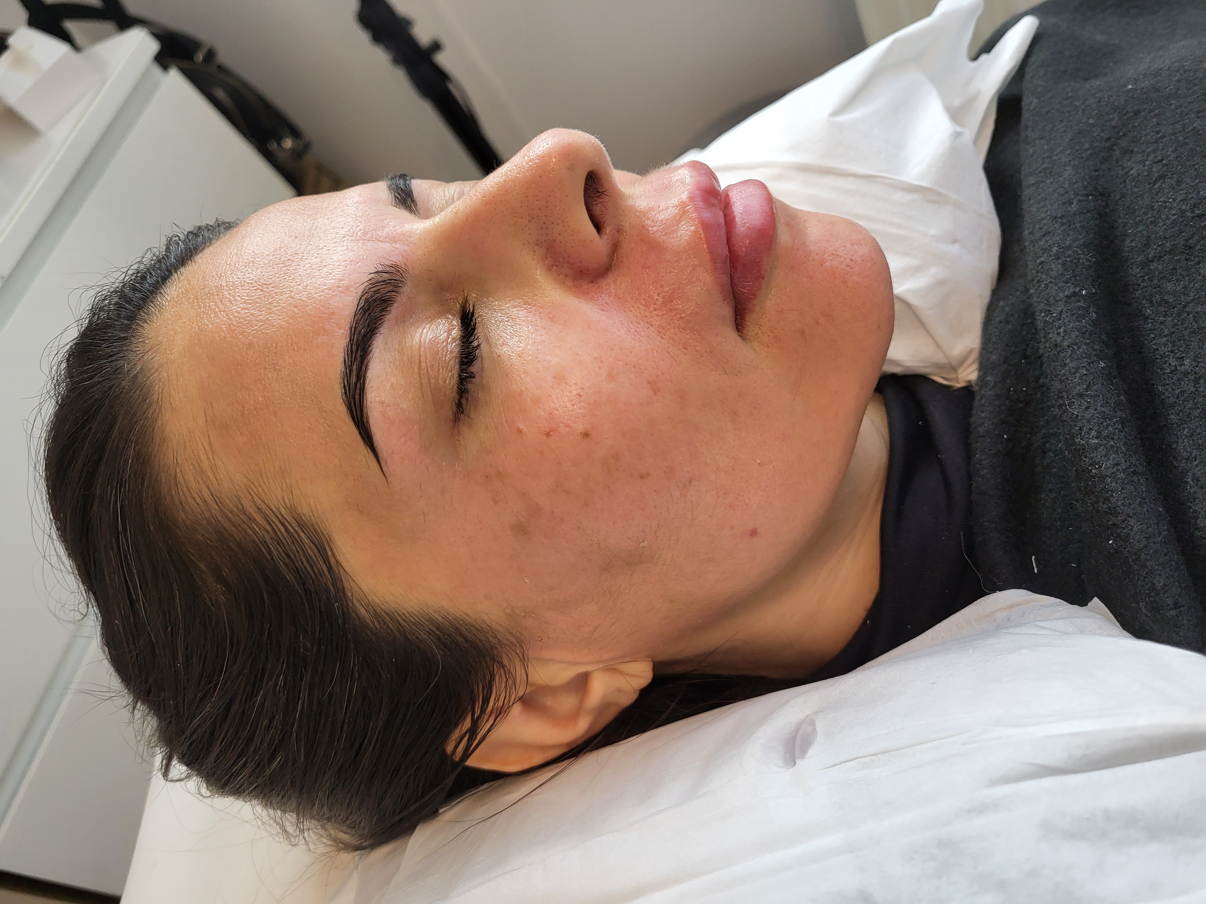 Harmonização Facial Depois